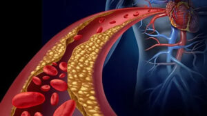 خطوات بسيطة لخفض نسبة الكوليسترول