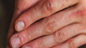 تعرف على علامات نقص الكالسيوم في الدم وطرق الوقاية