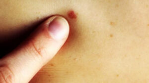 تعرف على أبرز 5 أسباب لظهور البثور في الجسم