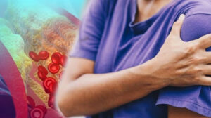 أعراض ارتفاع الضغط والكوليسترول