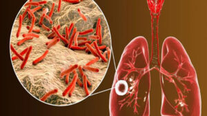 أنباء بظهور سلالات جديدة من مرض الدرن في مصر.. والصحة ترد