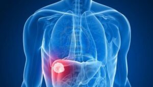 عادات تزيد من خطر الإصابة بالكبد الدهني