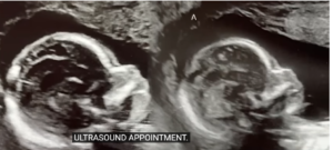 شاهد.. امرأة تحمل طفلين في رحمين مختلفين