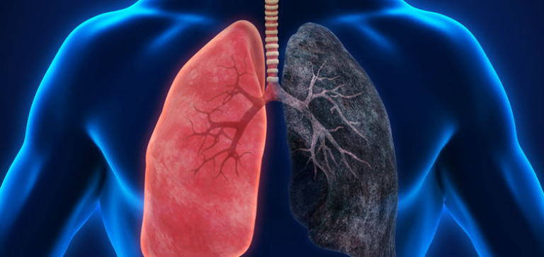 سرطان الرئة