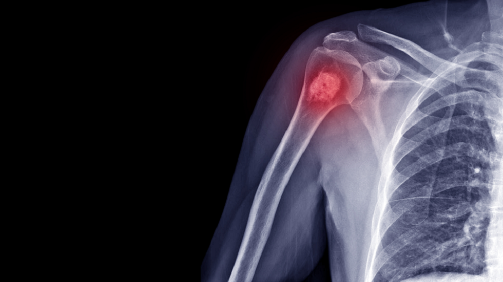 منها فقدان الوزن الغير مبرر.. أعراض الإصابة بسرطان العظام