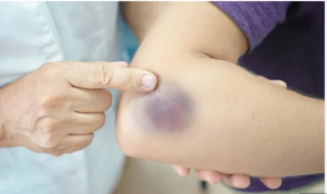 تعرف على علامات الإصابة بالسرطان