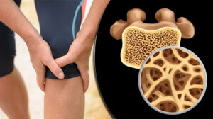 تعرف على أسباب هشاشة العظام