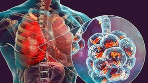 إذا كنت مصاب بالالتهاب الرئوي.. انتبه لهذه المضاعفات الخطيرة