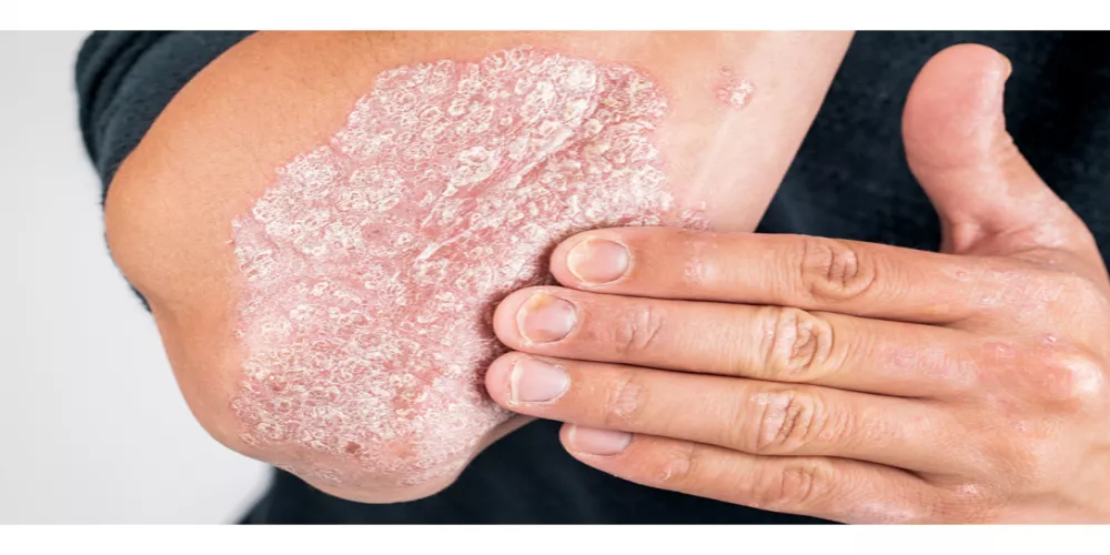 تعرف على أبرز أسباب الإصابة بمرض الصدفية وعلاجها