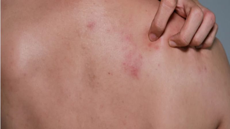 مضاعفات مرض الحزام الناري لكبار السن