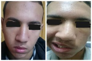 جراحة تعيد الأمل لمصاب بشلل في الوجه إثر طلق ناري