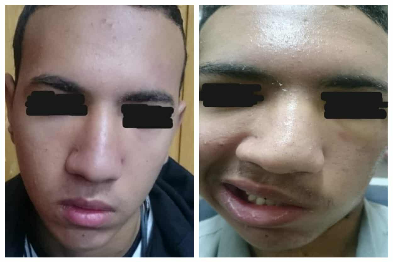 جراحة تعيد الأمل لمصاب بشلل في الوجه إثر طلق ناري