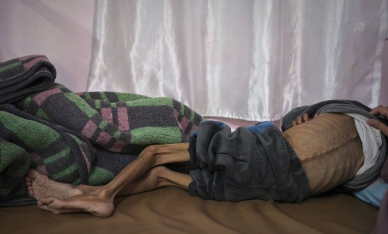 الأونروا: الجوع أصبح القاتل الأحدث في غزة