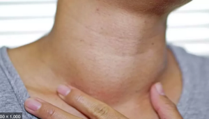 التهاب الغدد اللمفاوية.. إنذار مبكر من جهاز المناعة