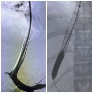 إنقاذ حياة فتاة تعاني من فشل كبدي بمستشفى الراجحي بجامعة أسيوط