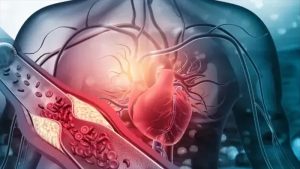 كل ما تريد معرفته عن هبوط القلب والذبحة الصدرية