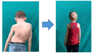 فريق طبي ينجح في إنهاء معاناة طفل من اعوجاج حاد بالعمود الفقري بمستشفى جامعة أسيوط