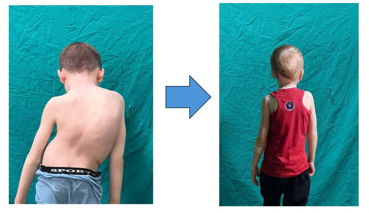 فريق طبي ينجح في إنهاء معاناة طفل من اعوجاج حاد بالعمود الفقري بمستشفى جامعة أسيوط